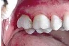 After — Metal filling replaced with ceramic restoration