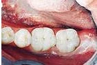 After — Amalgam fillings replaced with tooth-colored ceramic