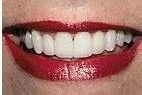 After — Discolored front teeth restored with porcelain veneers