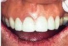 After — Custom veneers crafted and fitted in a single visit