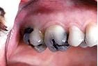 Before — Metal filling replaced with ceramic restoration