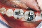 Before — Amalgam fillings replaced with tooth-colored ceramic