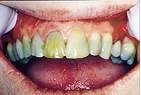 Before — Discolored front teeth restored with porcelain veneers