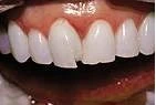 Before — Custom veneers crafted and fitted in a single visit